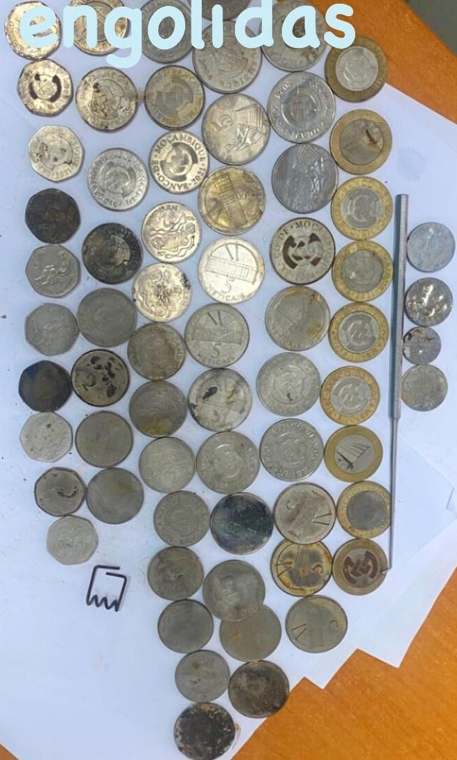 Pelo menos 250 meticais em moedas retirados de orgaos internos de pacientes em Nampula.jpg